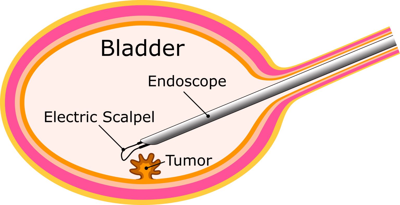 sbi-pharma-bladder-cancer-treatment-methods-ala